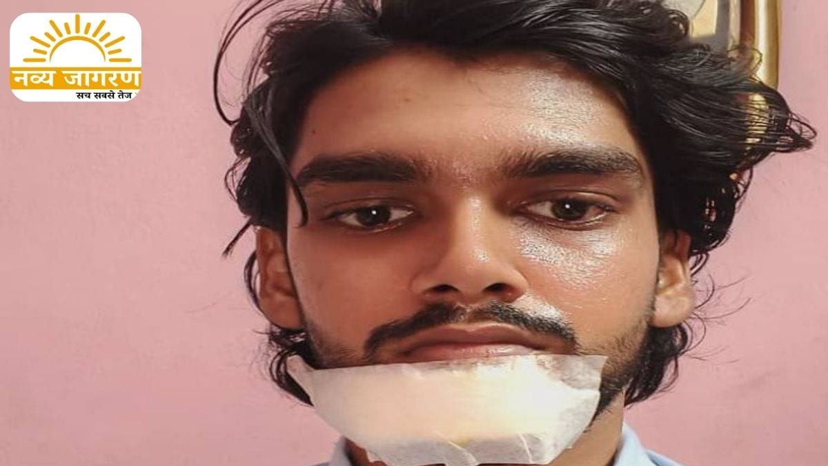 छात्र का कटा जबड़ा, डॉक्टरों ने लगाए 12 टांके